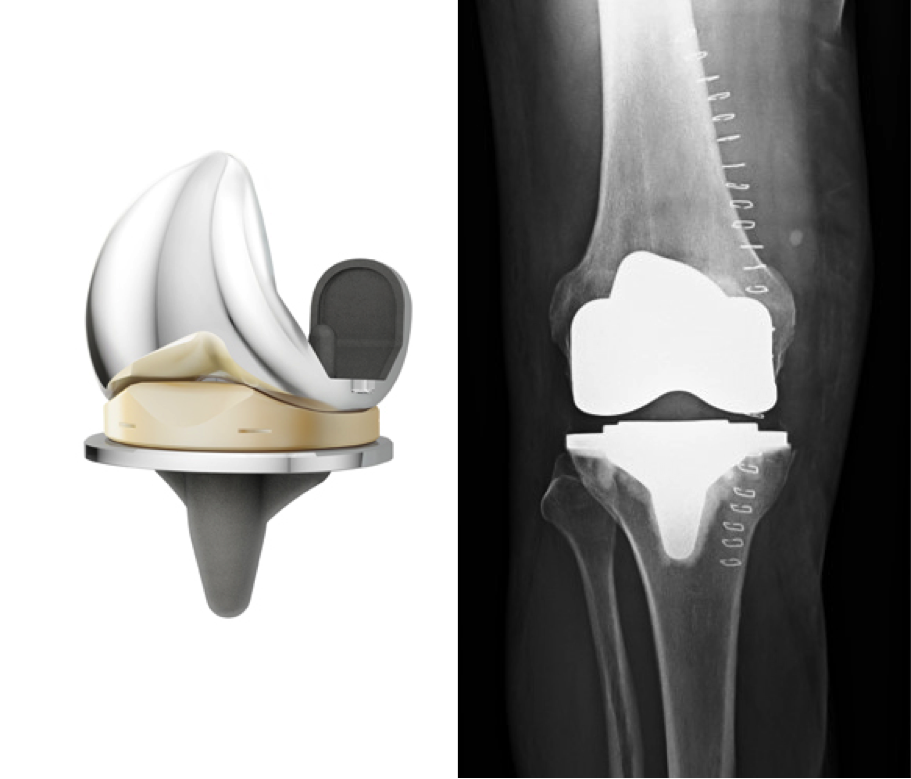 Komplettes künstliches Kniegelenk (Knie-Totalendoprothese) 