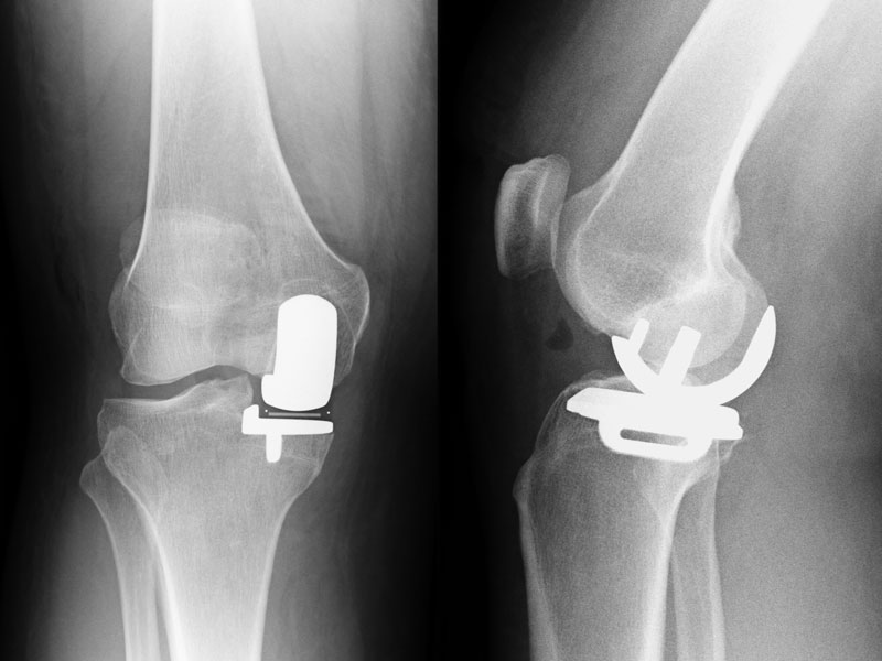 Oxford Schlittenprothese Röntgenbild zementfrei