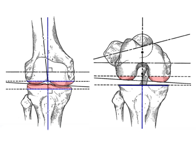 Schematisches Planungsbild für die Sägeschnitte einer Knieprothese