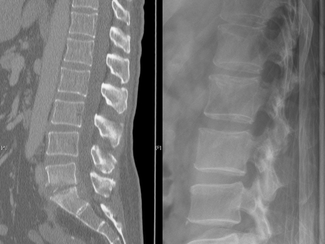 Spondylodiscitis LWK V / S I Röntgenbild und CT